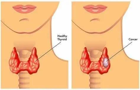 喝一杯“神仙水”就能治疗癌症？什么药物这么厉害