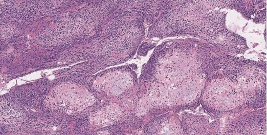 激光治癌新进展,治疗骨癌的最新技术