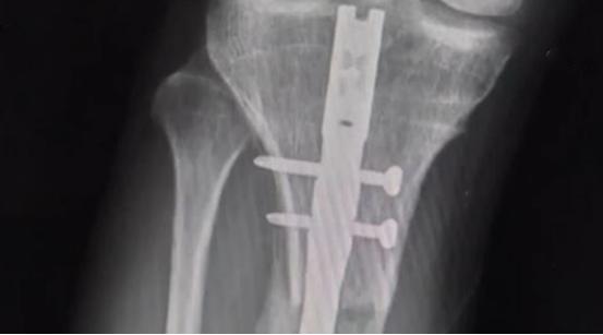 李亚诺断骨手术,断骨增高7.2厘米的李亚诺现状