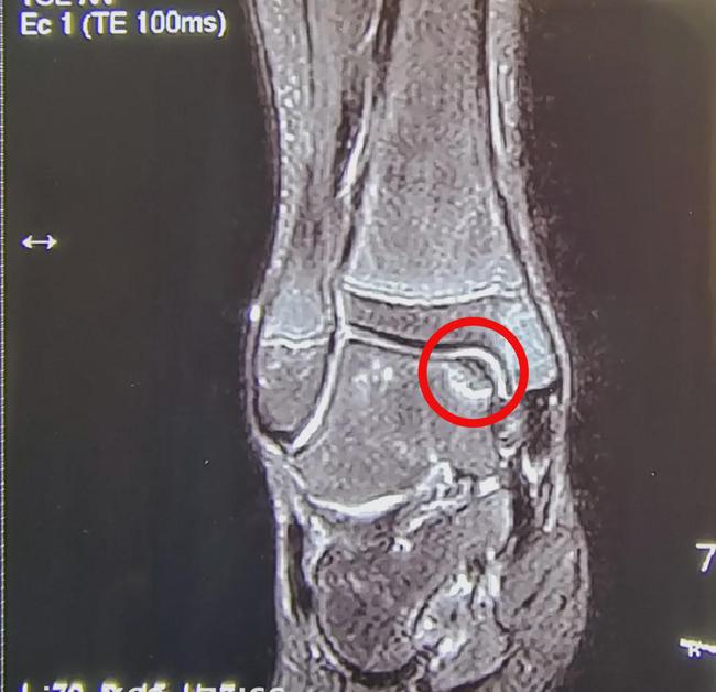 踝关节软骨损伤与踝关节炎区别,踝关节距骨软骨损伤怎么保护的