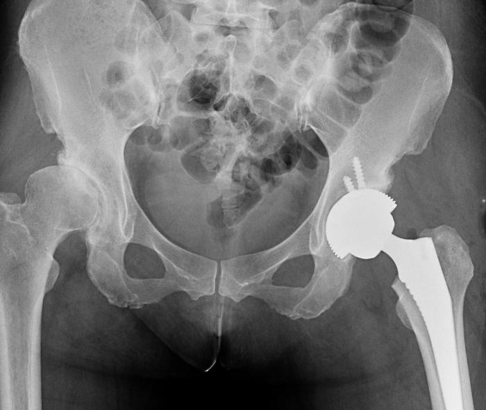 子宫里掉出小肉球,子宫内壁有肉突出来