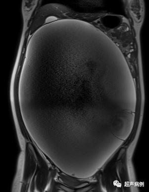 超声上第一次看到孩子的感受,超声检查实录