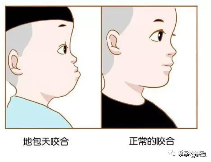 为什么整牙脸会小,为什么整牙期间脸会变老