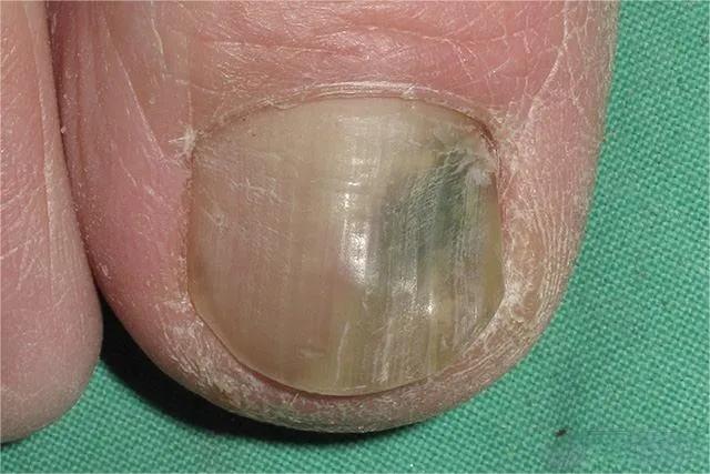 甲癣不严重怎么治疗,甲易生治疗灰指甲吗