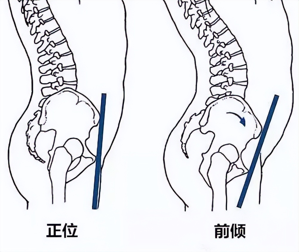 屁股太翘是什么病,屁股翘的病