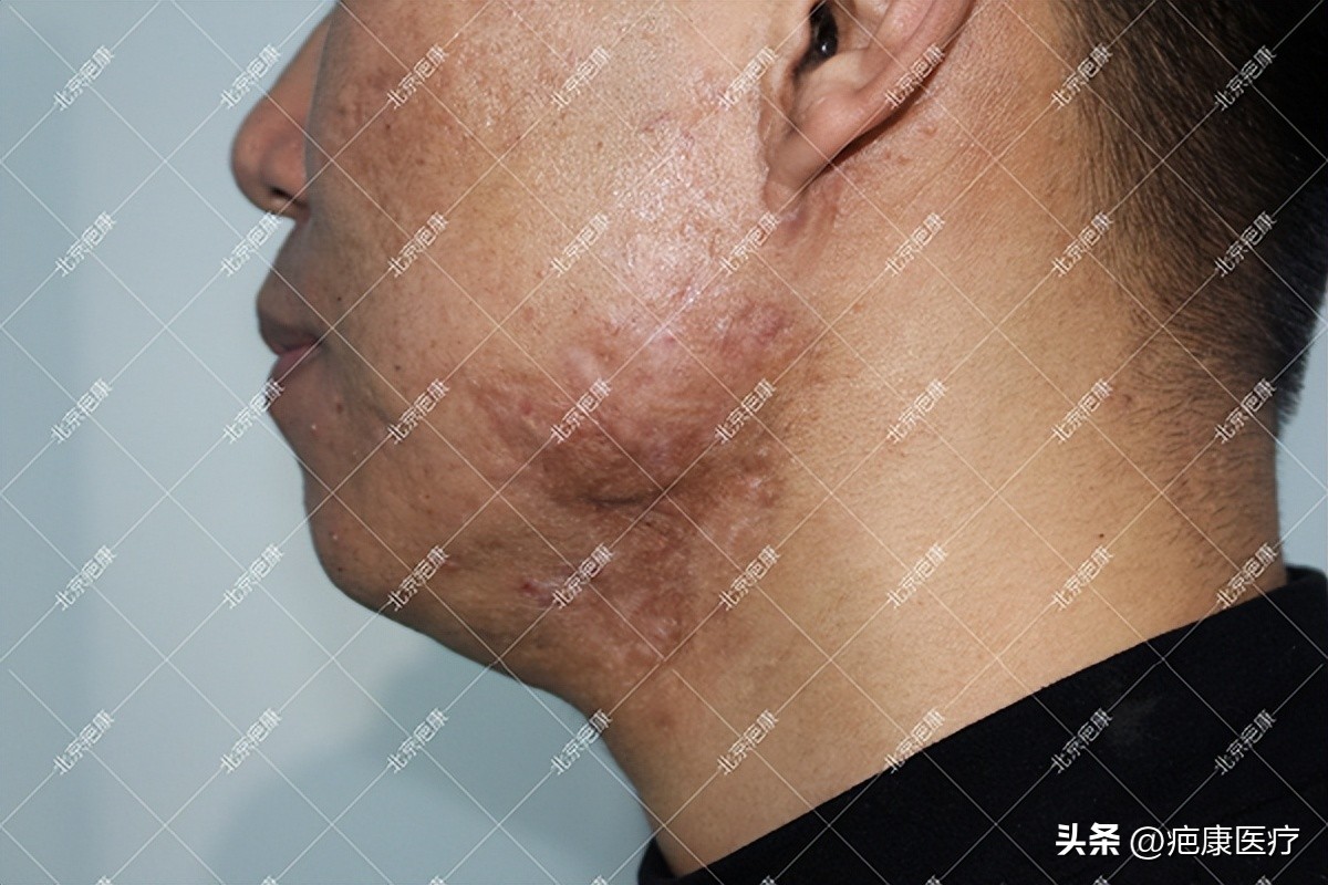脸颊疤痕疙瘩治疗过程图,疤痕疙瘩脸颊