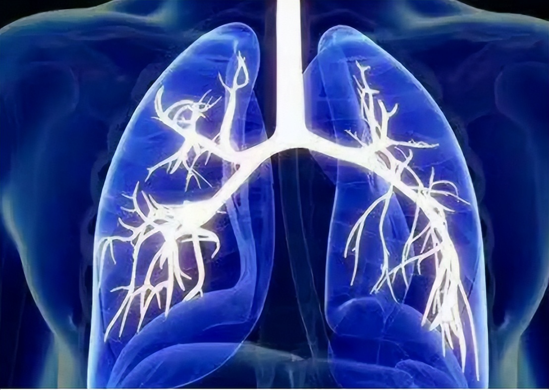 胸腔积液是属于重大疾病吗,胸腔积液一般是由什么原因导致的