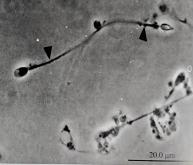 uu感染会自愈么,uu感染是hiv吗