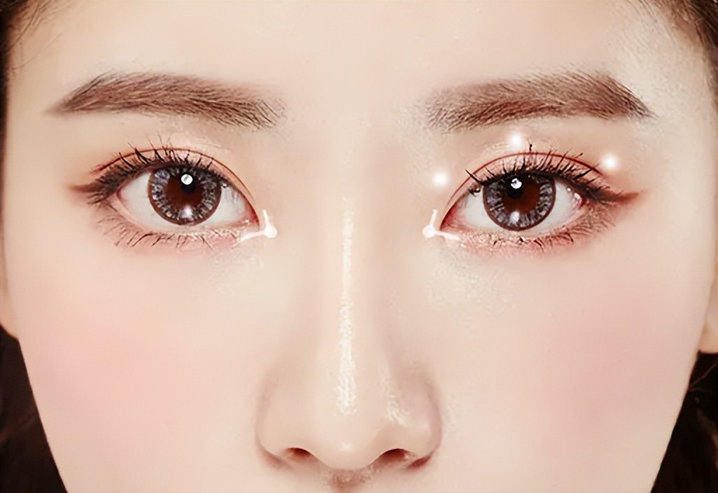 本身是双眼皮还能做眼综合吗,眼睛很小割双眼皮不开眼角可以吗