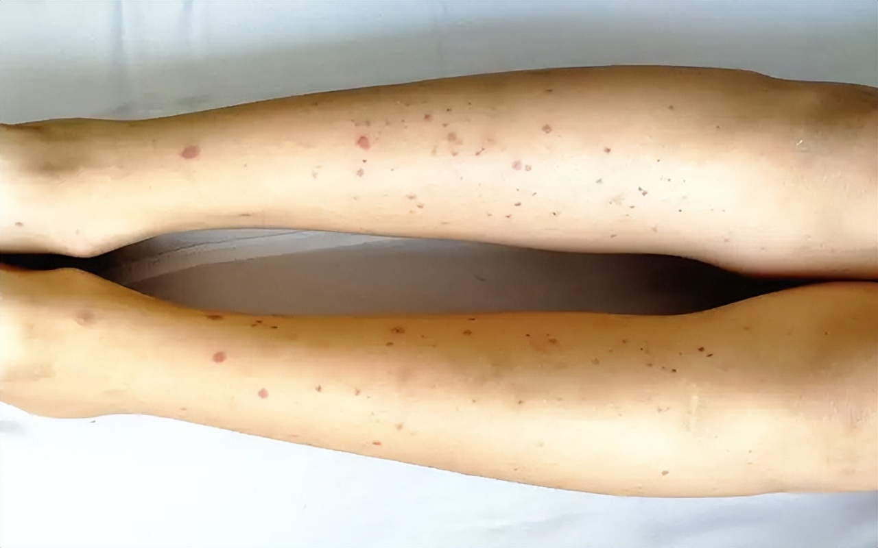 紫癜好了之后总是出针尖样小点,紫癜恢复期有针尖出血点