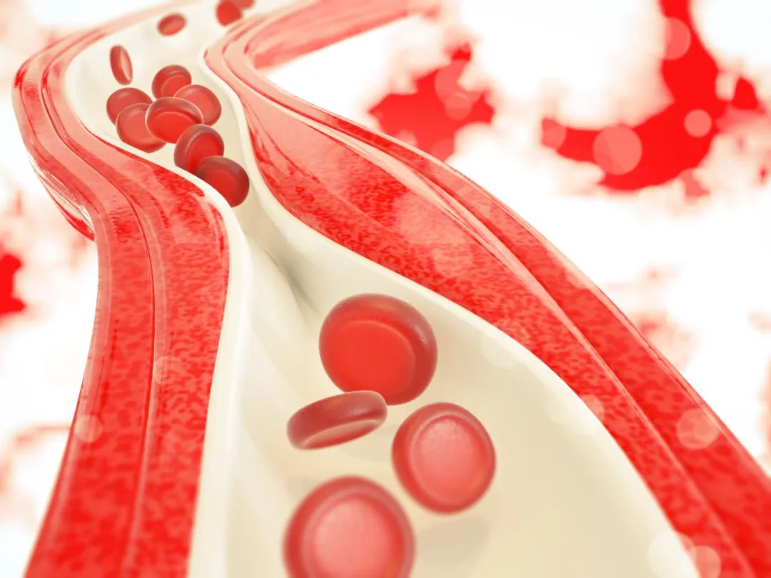动脉硬化最佳治疗用药,动脉硬化最怕3个动作