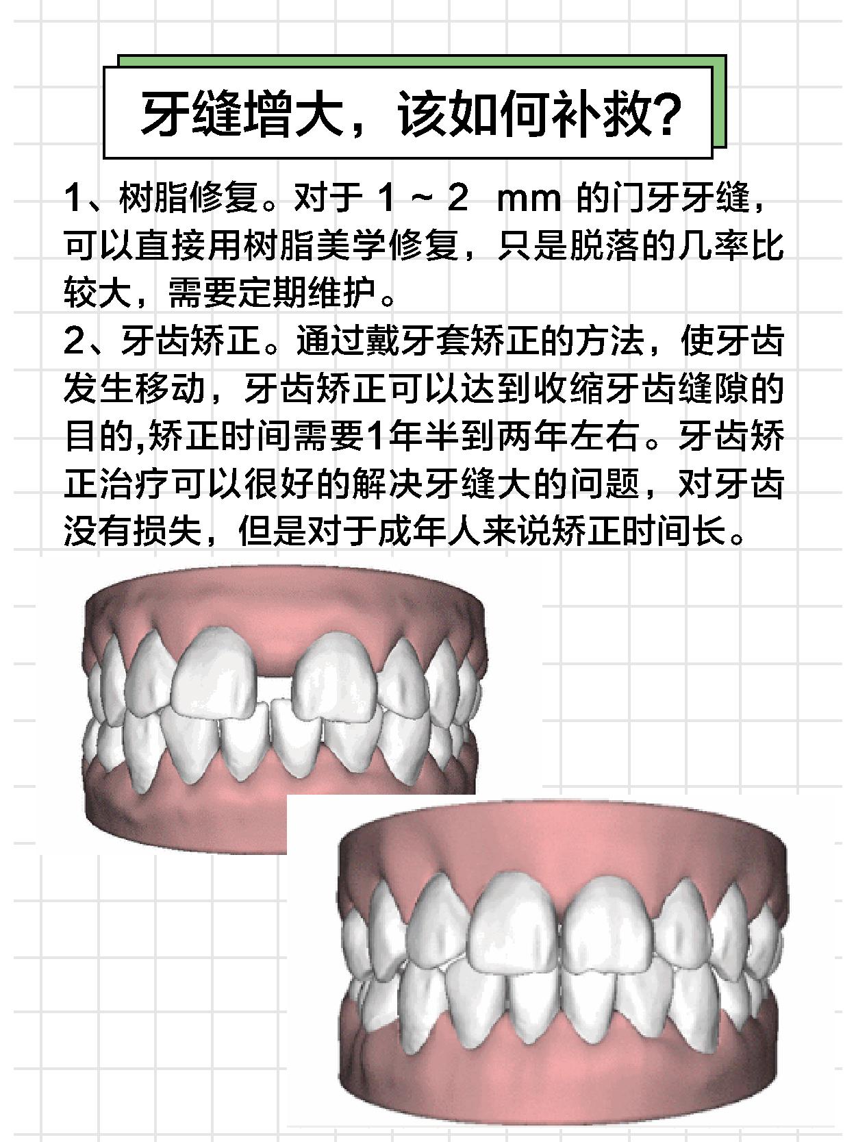 牙周炎导致牙肉萎缩牙缝增大,牙缝变大的原因及处理方法