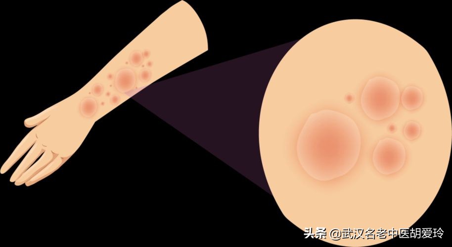 脸上起皮屑发红怎么回事,脸上起皮屑像癣一样边界清晰