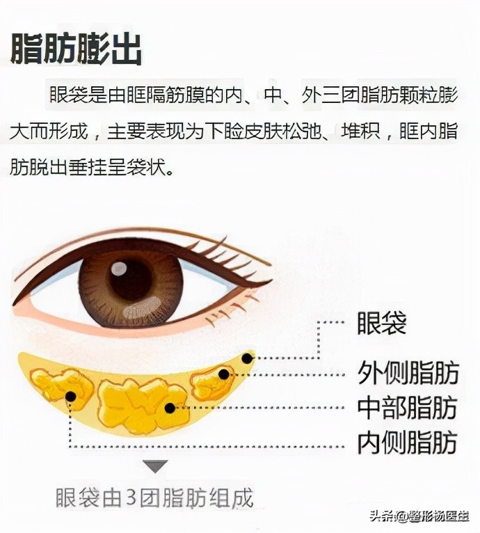 割完眼袋眼肿为什么,割完眼袋显得眼凶