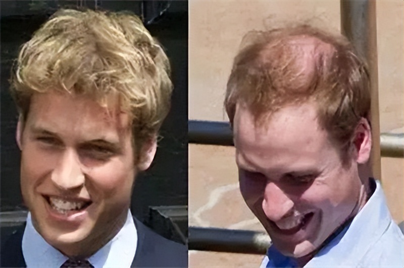 连明星都逃脱不了的高发际线时尚,雄秃现状