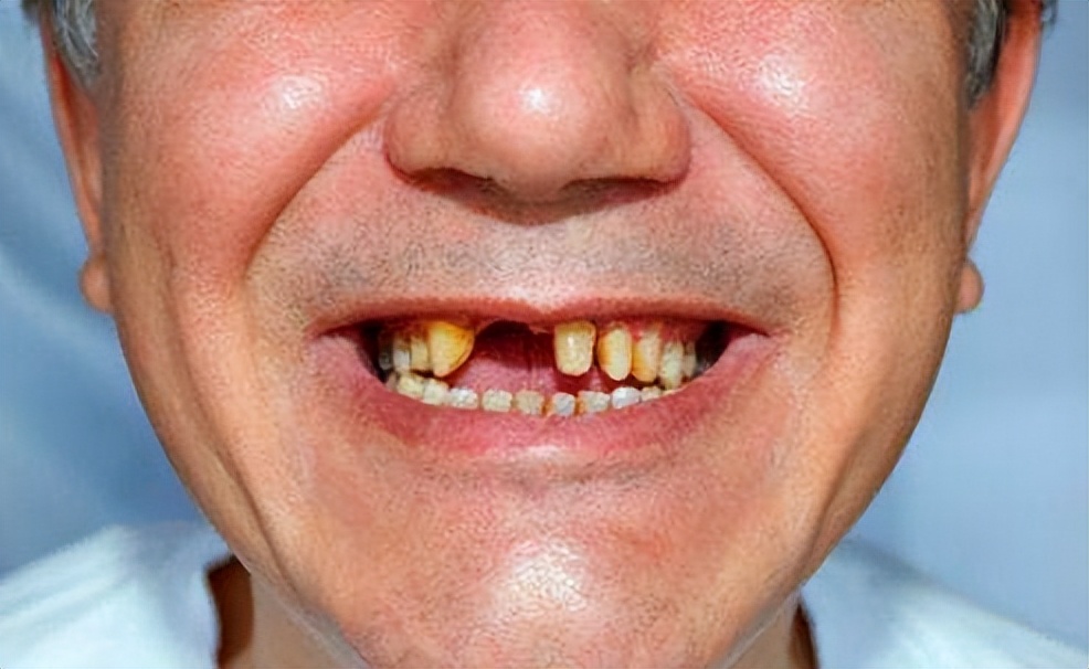 牙齿松动自然掉牙最快的方法,牙齿松动一般多久可以掉牙