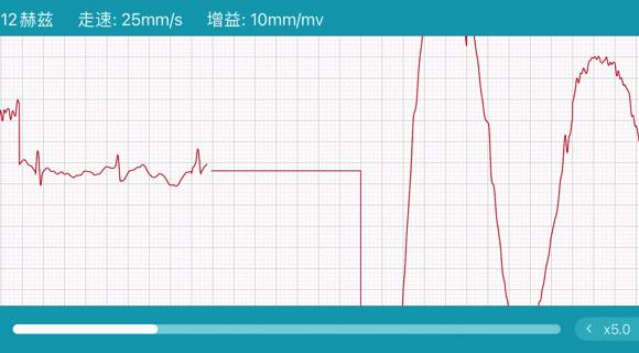 无创血糖测评,无创测血糖华为watch4