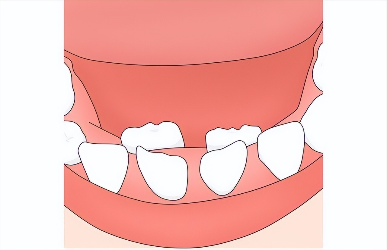 儿童满口蛀牙该怎么护理牙齿,上海孩子有蛀牙牙疼怎么办
