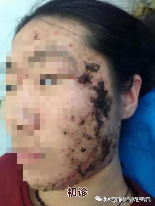 长治市中医研究所附属医院皮肤科用“火针+中药+倒模”疗法成功治疗一例中重度*疮痤**患者