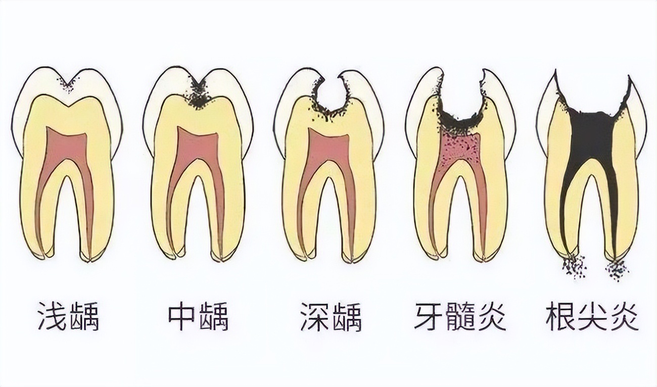 龋齿龋坏过程是怎样的？有什么修复方法？