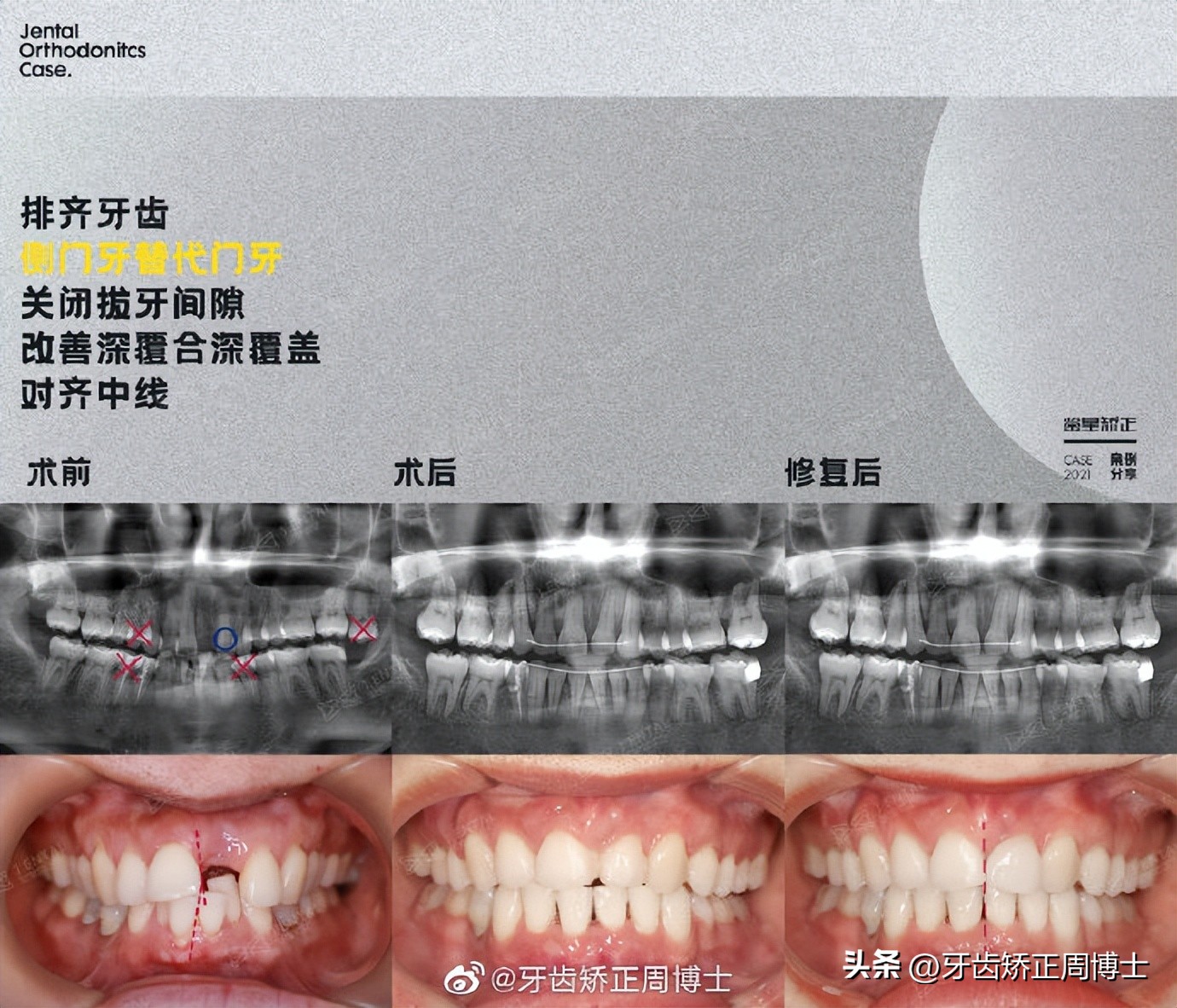 骨性前突正畸后多长时间有效果,牙性下巴后缩可以戴牙套改善吗