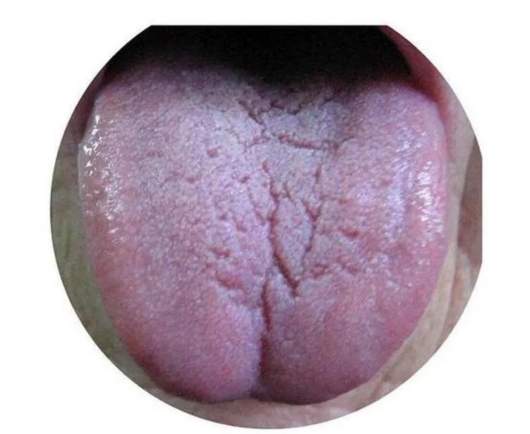 舌头裂纹到底吃什么药更有效,裂纹舌吃什么药能缓解