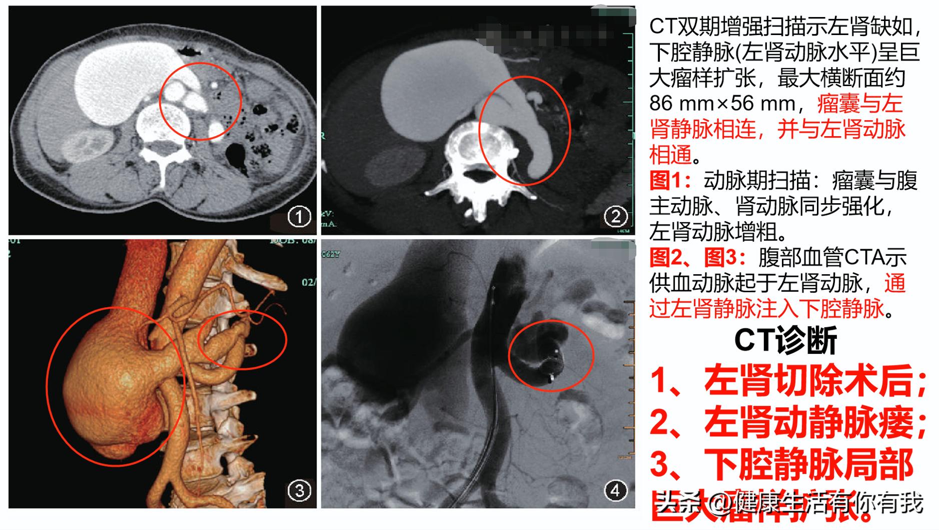 什么是血尿和尿潜血,什么是血尿是怎么回事