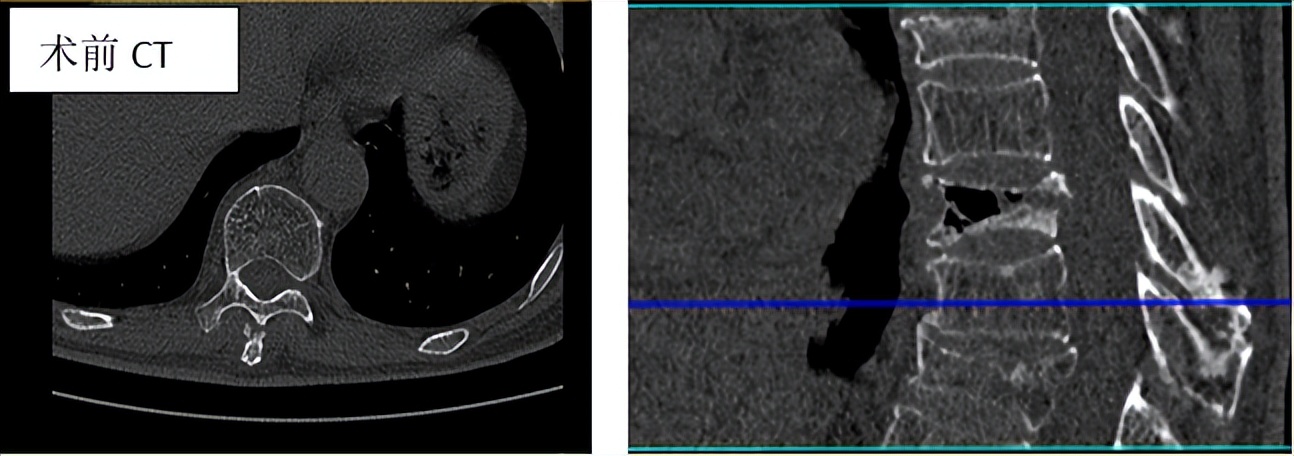 胸腰椎压缩性骨折特色治疗方法,老年人胸腰椎骨折怎么治疗