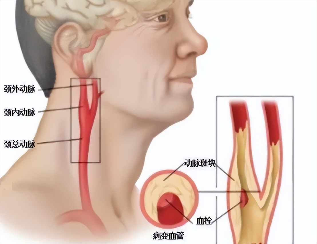 冠心病诊断预测模型,建模预测冠心病