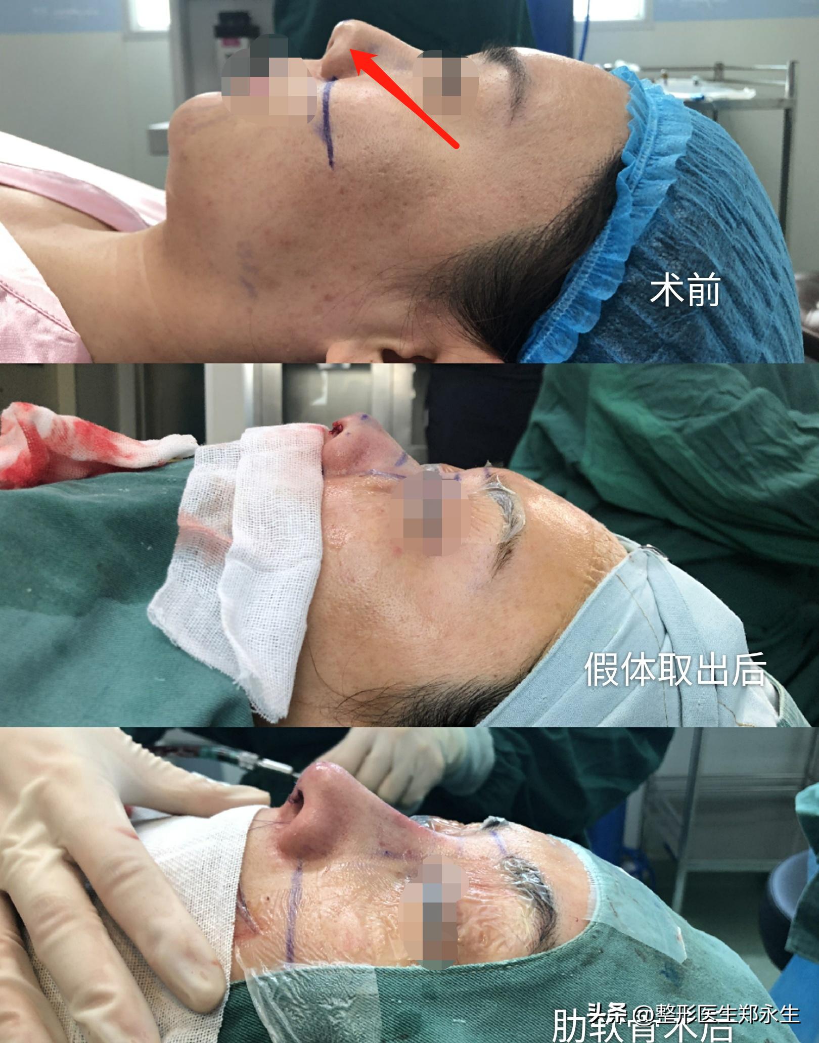 修复隆鼻不满意最佳取出时间,如何进行隆鼻失败修复