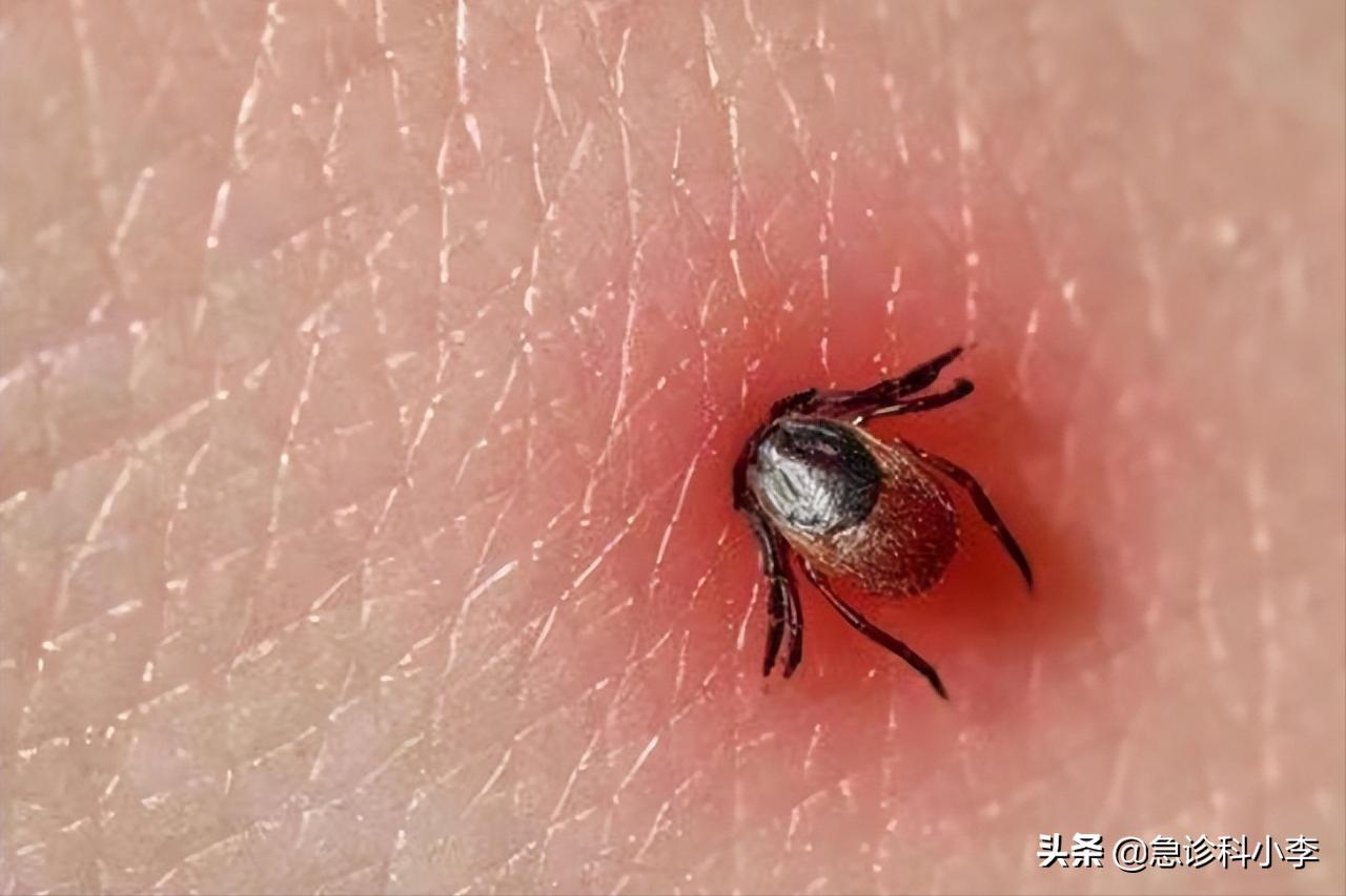 蜱虫咬人死亡率多少,蜱虫咬后死亡率新闻