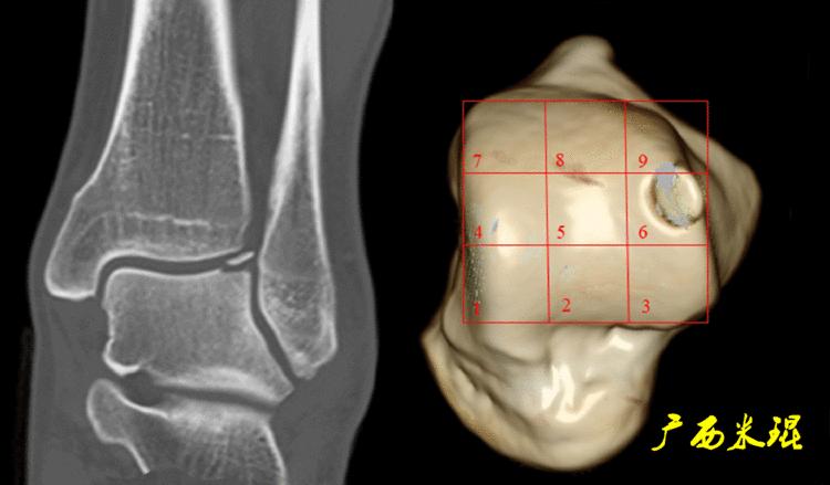距骨软骨损伤最好的治疗方法,距骨软骨损伤的诊断