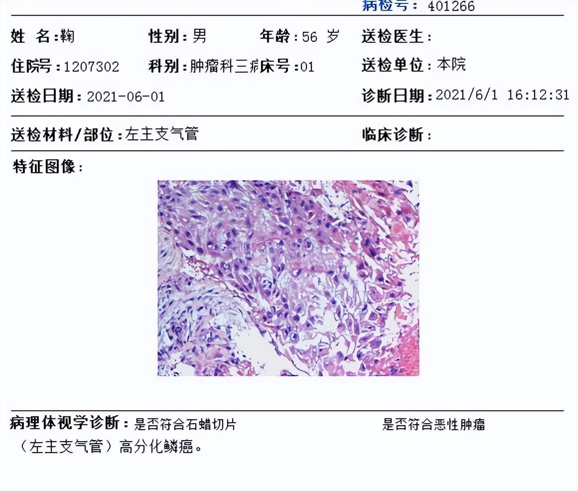 免疫治疗6次后肿瘤消失了,肺鳞癌中晚期化疗联合免疫治疗