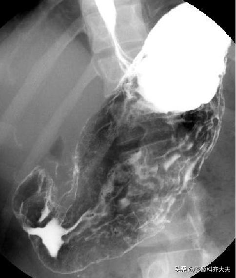 胃肠道造影超声解剖图,胃肠钡餐影像检查片子