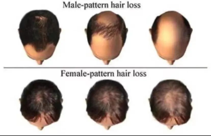 富血小板血浆治疗骨质增生吗,富血小板治疗脂溢性脱发