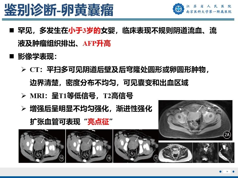 好文分享——《胚胎型横纹肌肉瘤》