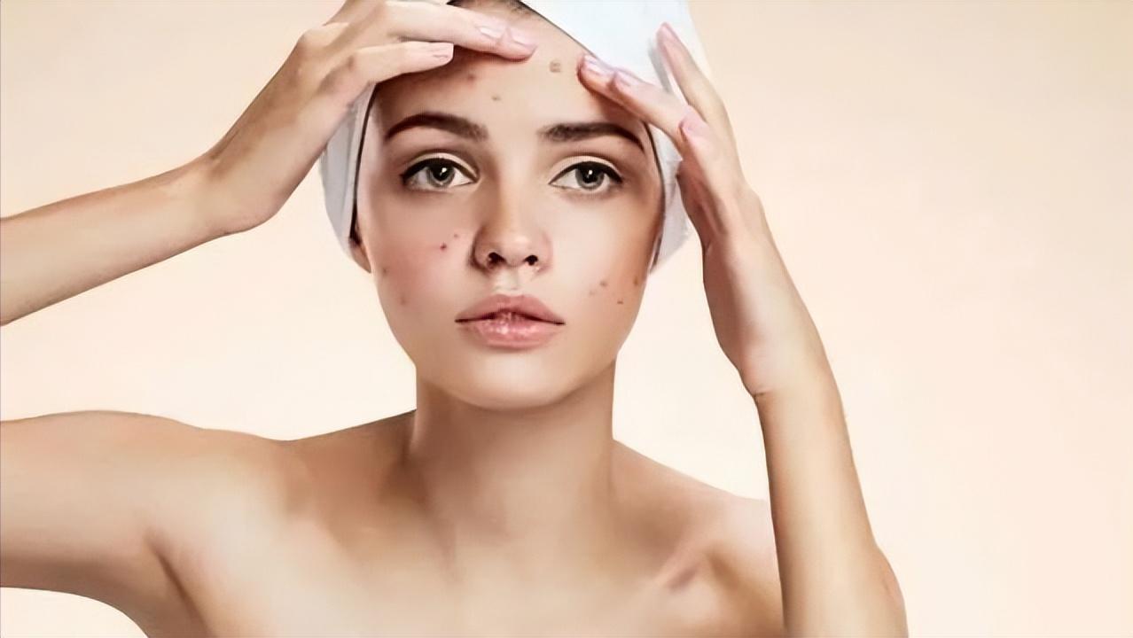 脸上长痘疮怎么去掉小妙招,脸上长痘疮的快速解决方法