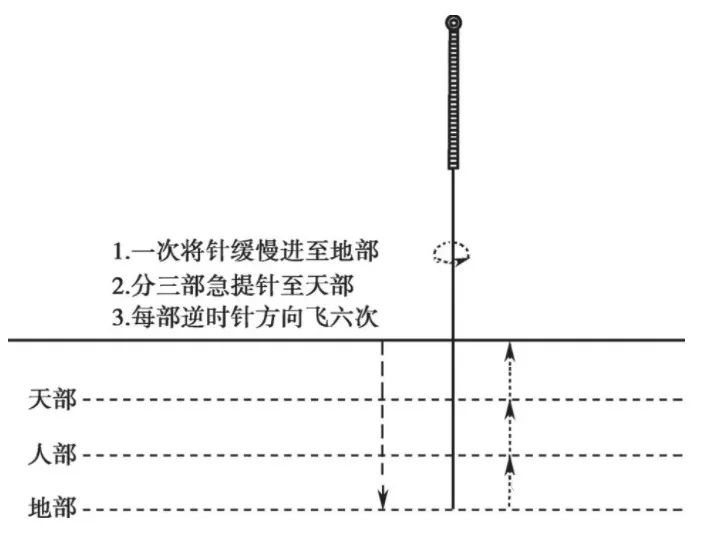 足三里补泻针灸手法图解,肩疼针灸补泻手法图解