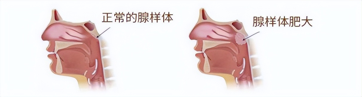 扁桃体肥大一定要切除吗9岁,扁桃体肥大一定要切除吗10岁