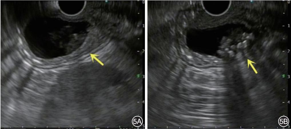 急性胰腺炎的病理类型及病变特点,急性化脓性胰腺炎临床表现