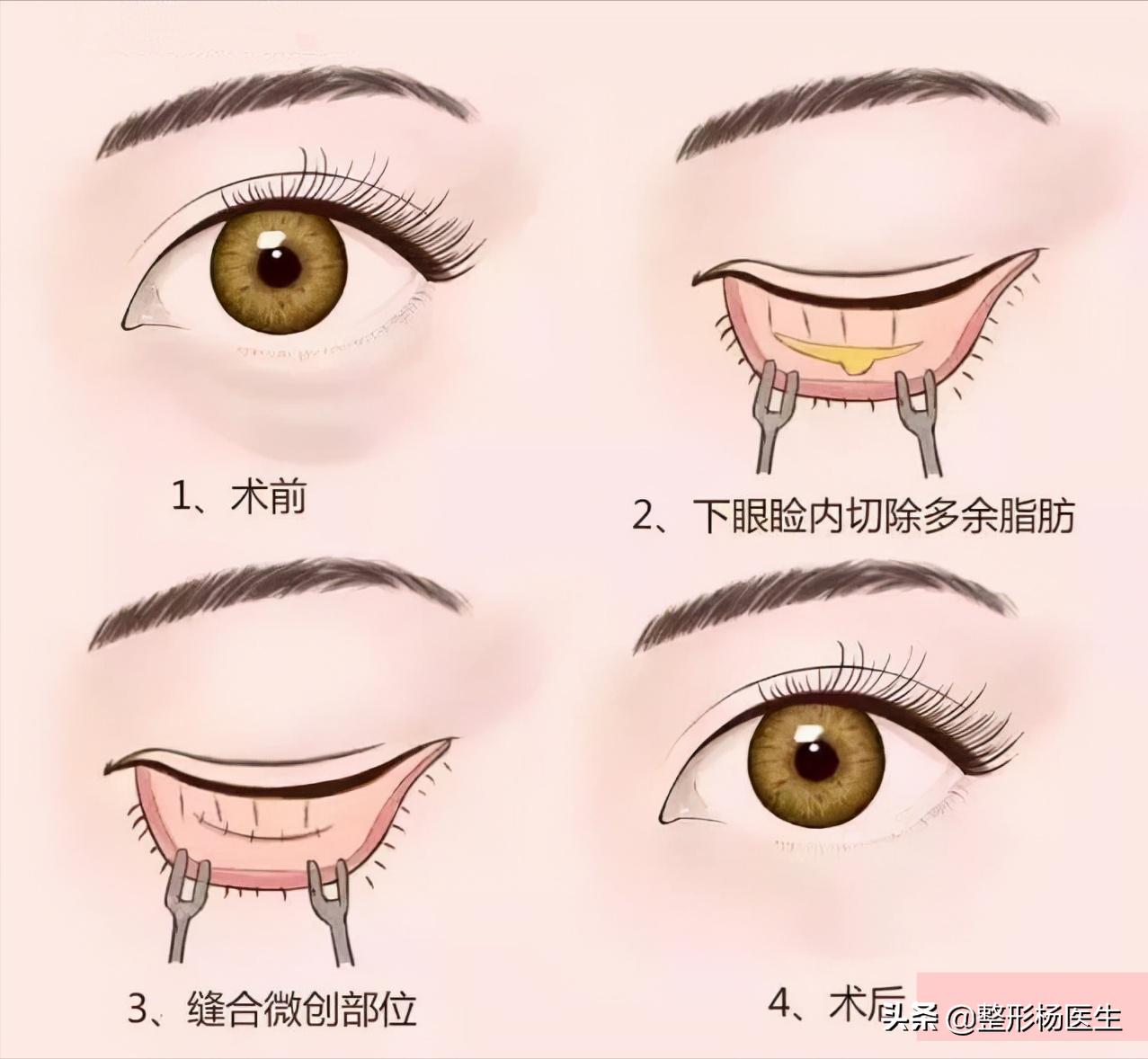 眼袋手术后真的显年轻吗,割眼袋能年轻几岁