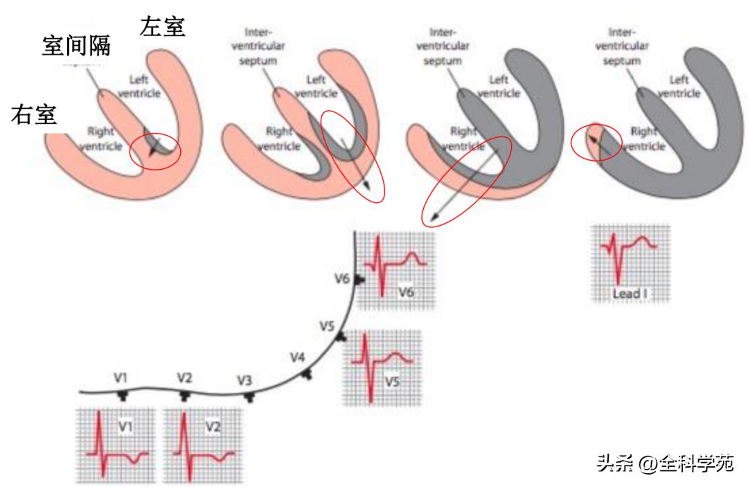 心电图笔记26：QRS波振幅变高，需要想到哪些