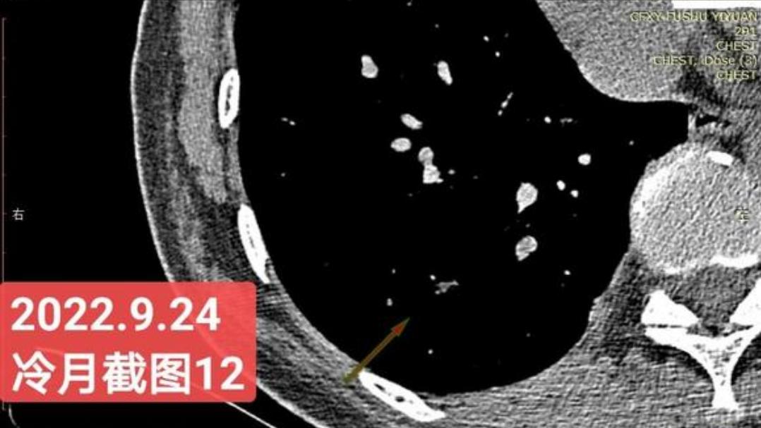 7mm肺结节恶性的怎么办,7mm实性肺结节危险程度