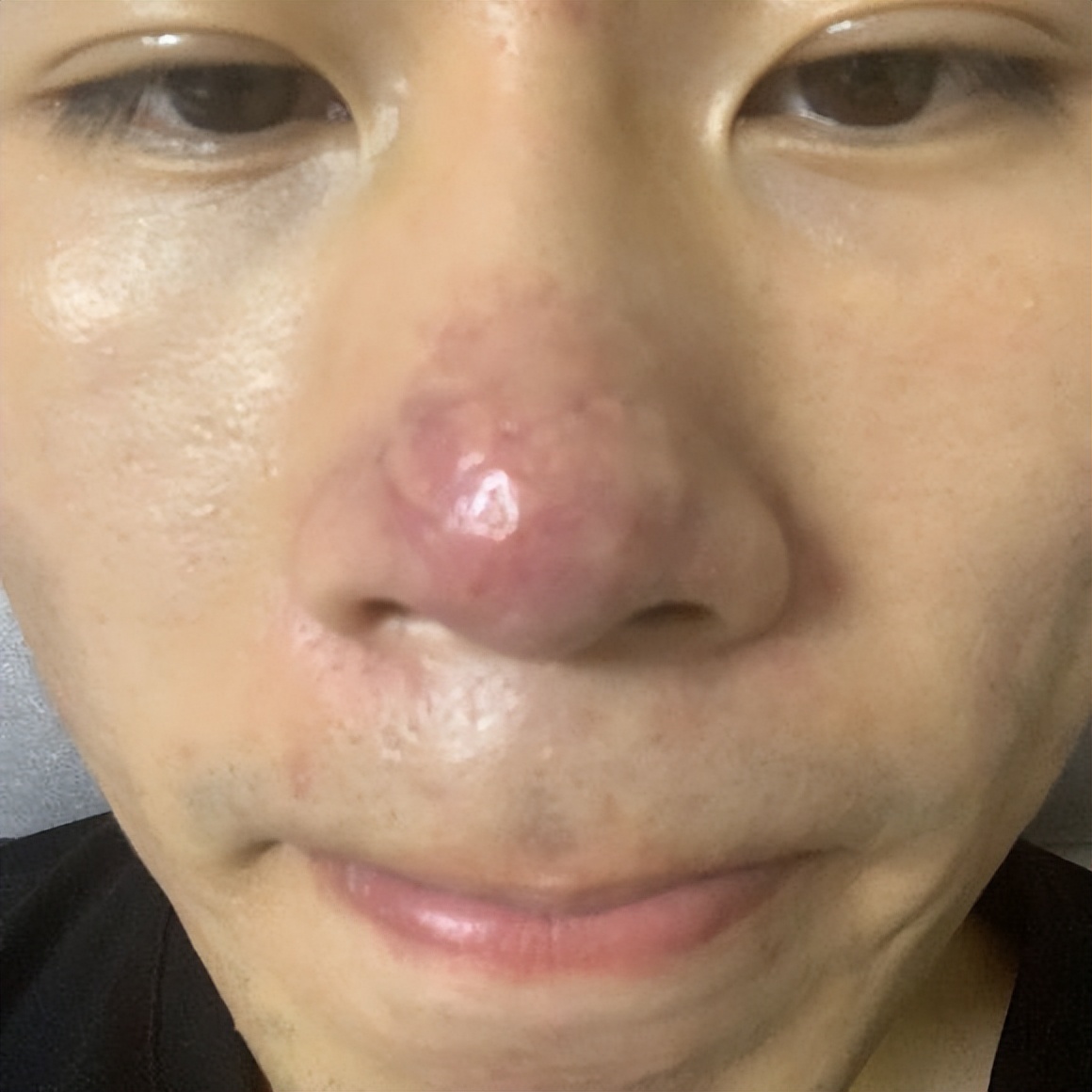 鼻子毛孔大能挤出好多脂肪粒,鼻子上长了像脂肪粒的东西