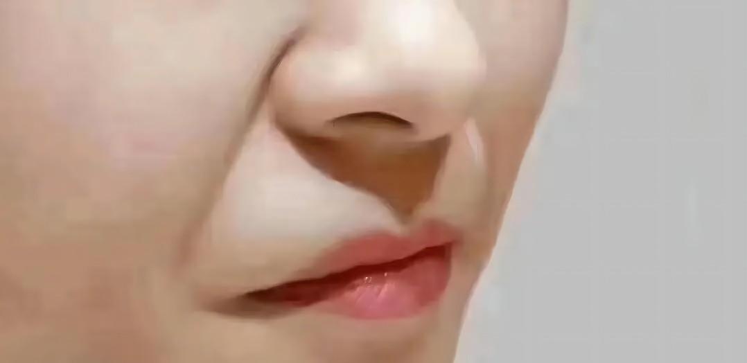 法令纹到底该怎么去除,如何正确的消除法令纹