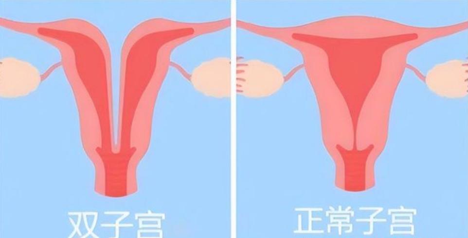 24岁女孩检出两个阴道，还有双子宫？医生解答，详细告诉你怎么办