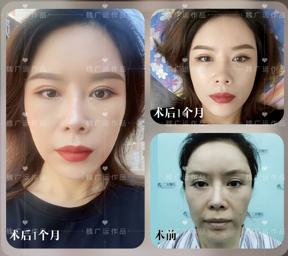 做个面部拉皮手术要多少钱啊,拉皮手术多长时间能全部消肿