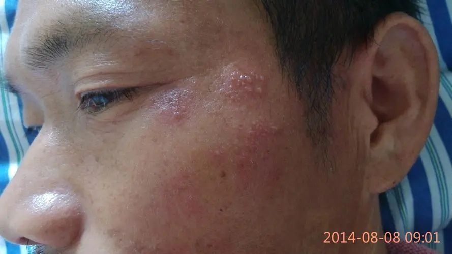 带状疱疹疫苗1401多少钱一支,带状疱疹疫苗有必要打几针