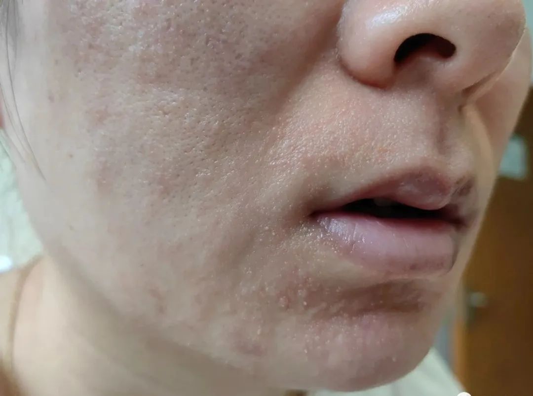 面部皮炎是炎症吗,脂溢性皮炎面部痒