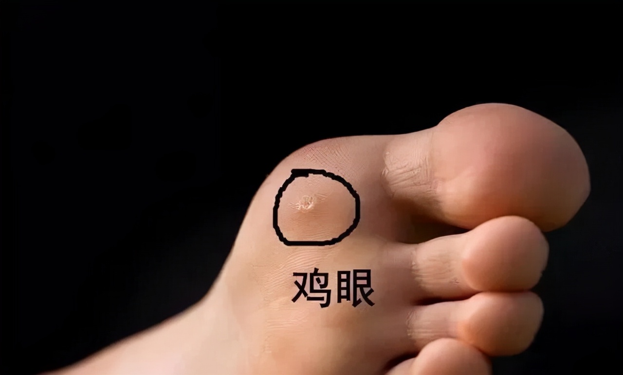前脚掌长鸡眼有什么治疗方法,脚趾头长鸡眼如何快速治疗